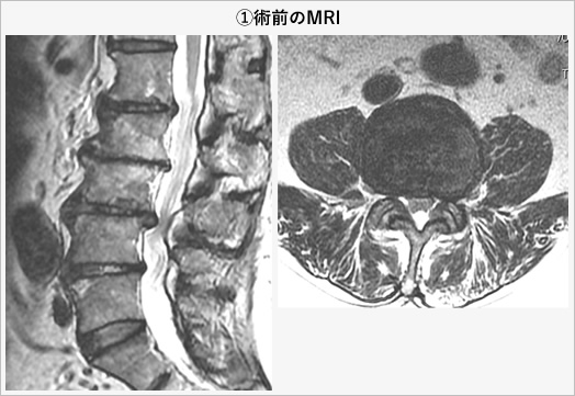 1)術前のMRI