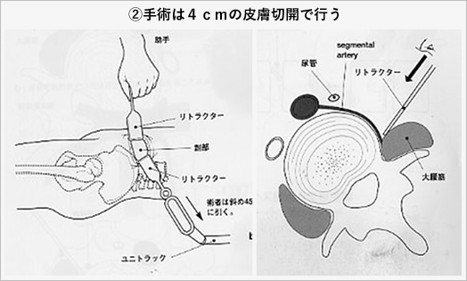 2)手術は４ｃｍの皮膚切開で行う