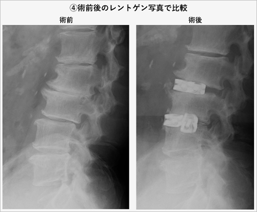 4)術前後のレントゲン写真で比較