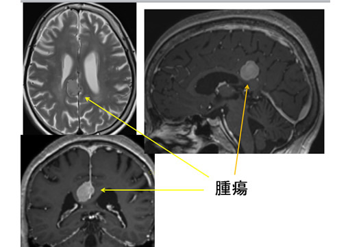 腫瘍