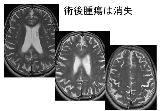 術後腫瘍は消失