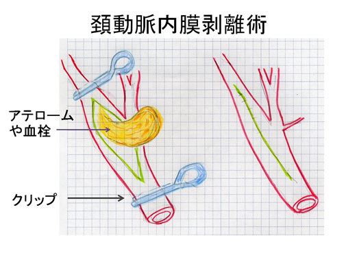 頸動脈内膜剥離術