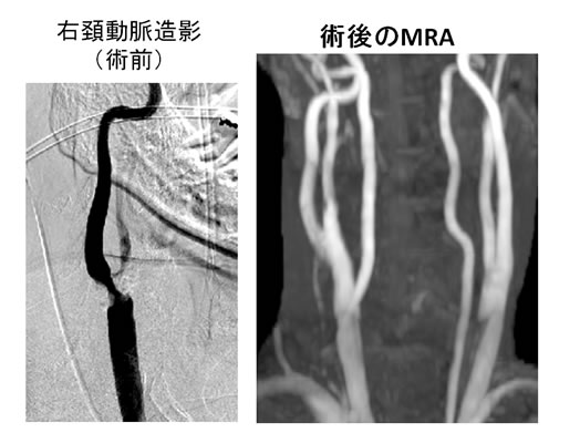 術後のMRA