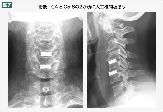 術後　C4-5,C5-6の2か所に人工椎間板あり