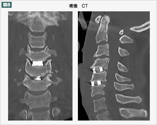 術後　CT