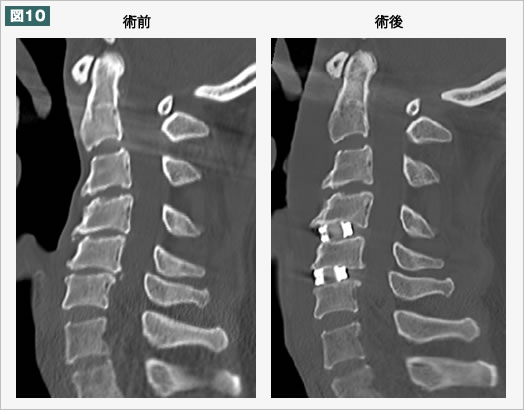 術後　CT