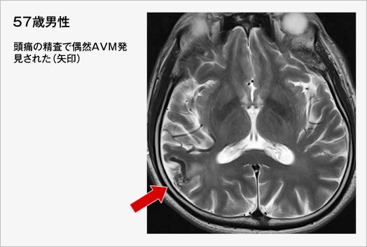 57歳男性　頭痛の精査で偶然AVM発見された（矢印）