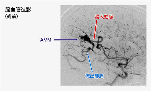 脳血管造影（術前）